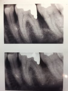 Bone Graft x-ray