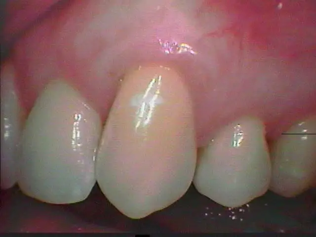 Soft Tissue Grafting After