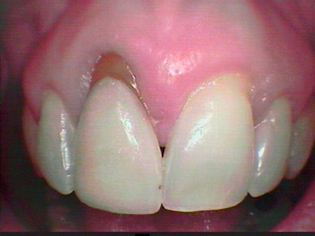 Soft Tissue Grafting Before