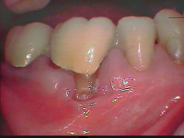 Soft Tissue Grafting Before