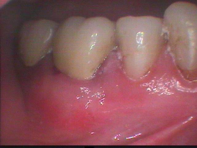 Soft Tissue Grafting After