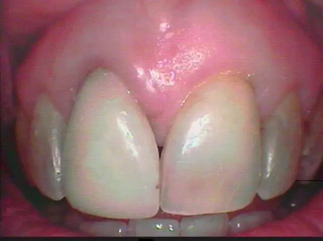Soft Tissue Grafting After