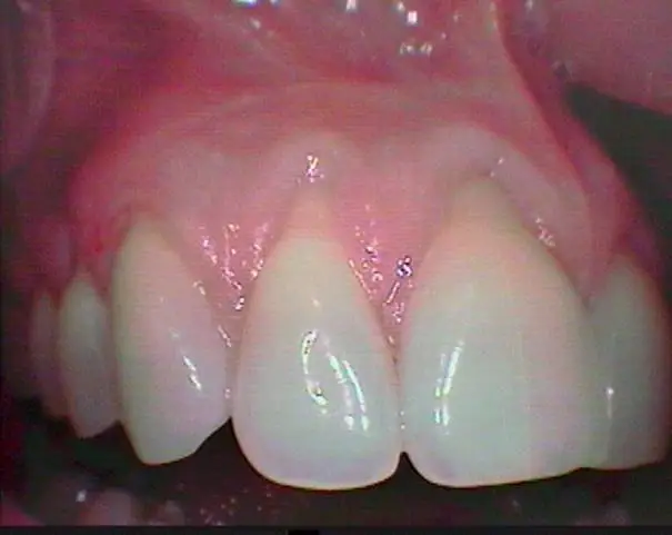 Soft Tissue Grafting Before