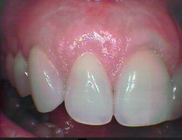Soft Tissue Grafting After