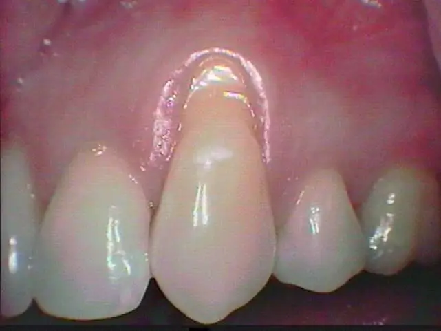 Soft Tissue Grafting Before