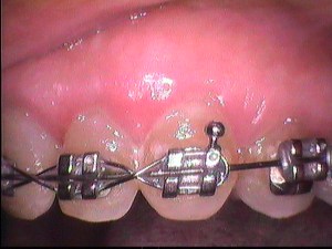 After Crown Lengthening