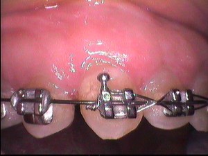 After Crown Lengthening