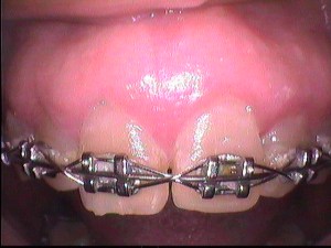After Crown Lengthening
