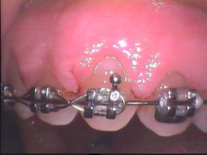 Before Crown Lengthening
