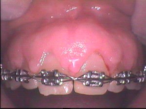 Before Crown Lengthening